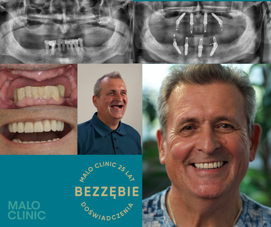 All-on-4 standard All-on-4 standard